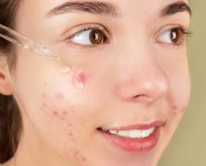 Tjej med acne som använder salicylsyra