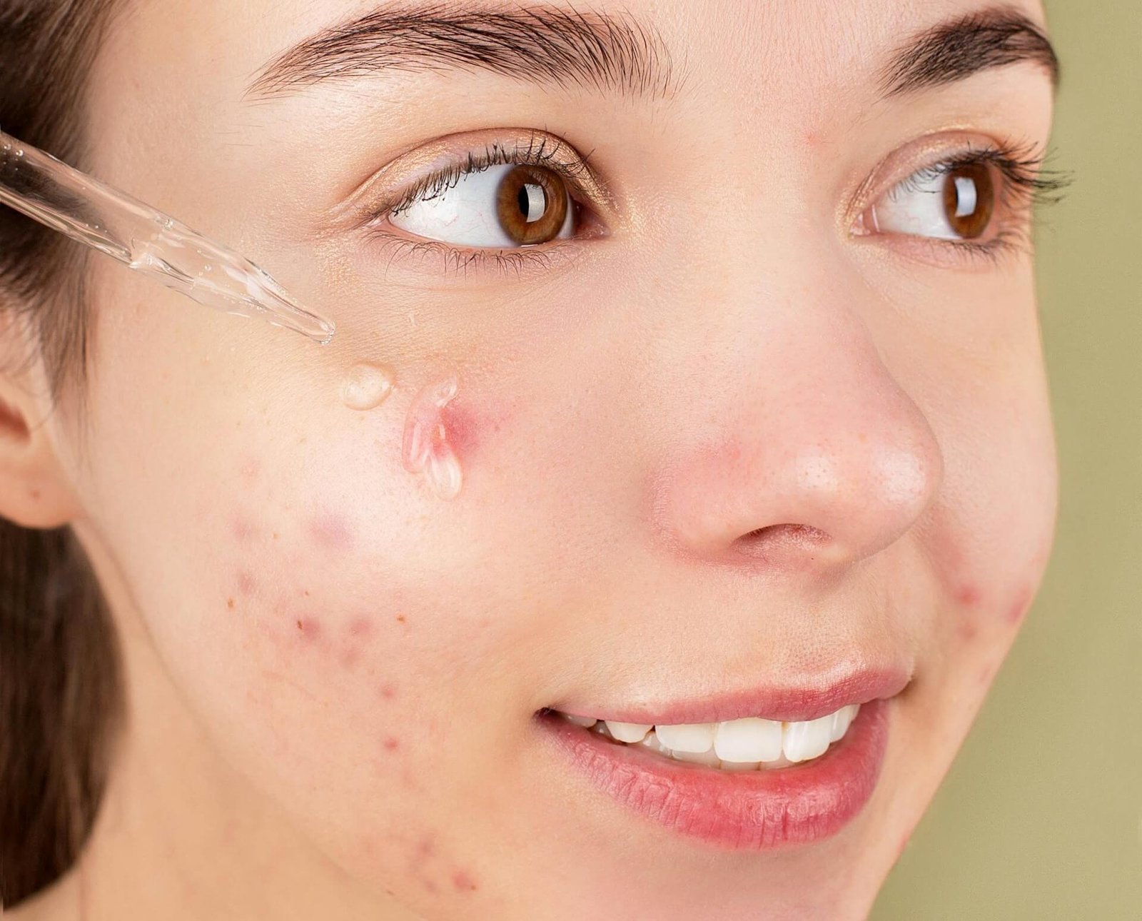 Tjej med acne som använder salicylsyra